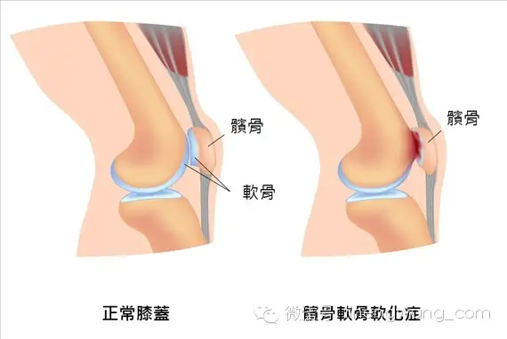 保护膝盖的运动器材_膝盖保护锻炼_